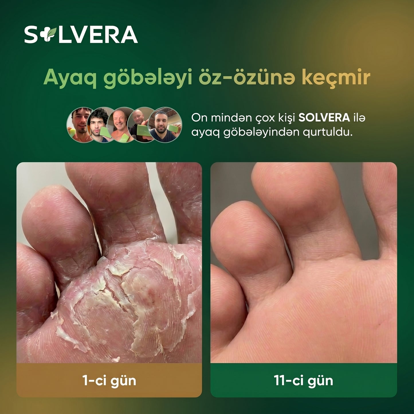 Solvera | Göbələk Əleyhinə Təbii Sabun