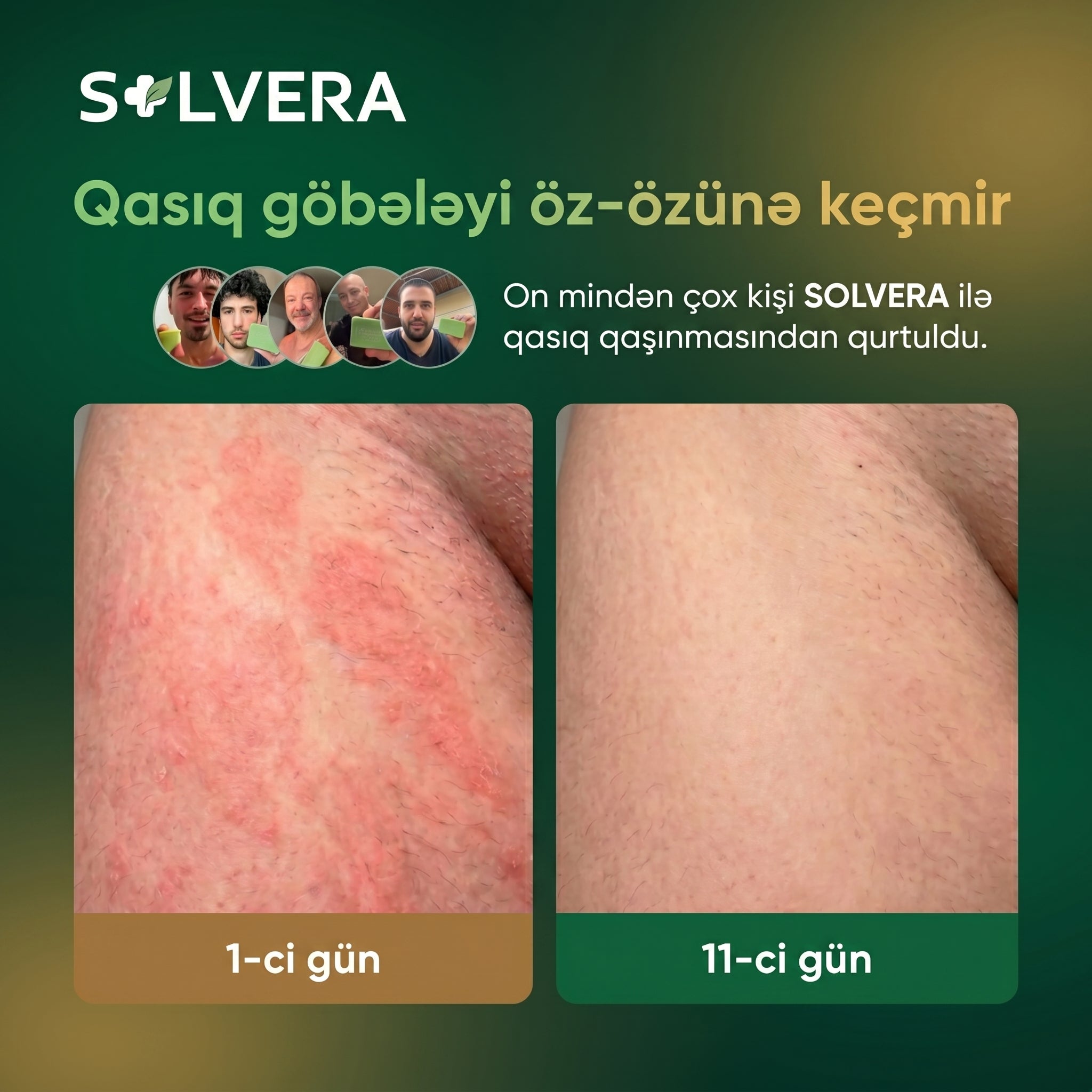 Solvera | Göbələk Əleyhinə Təbii Sabun